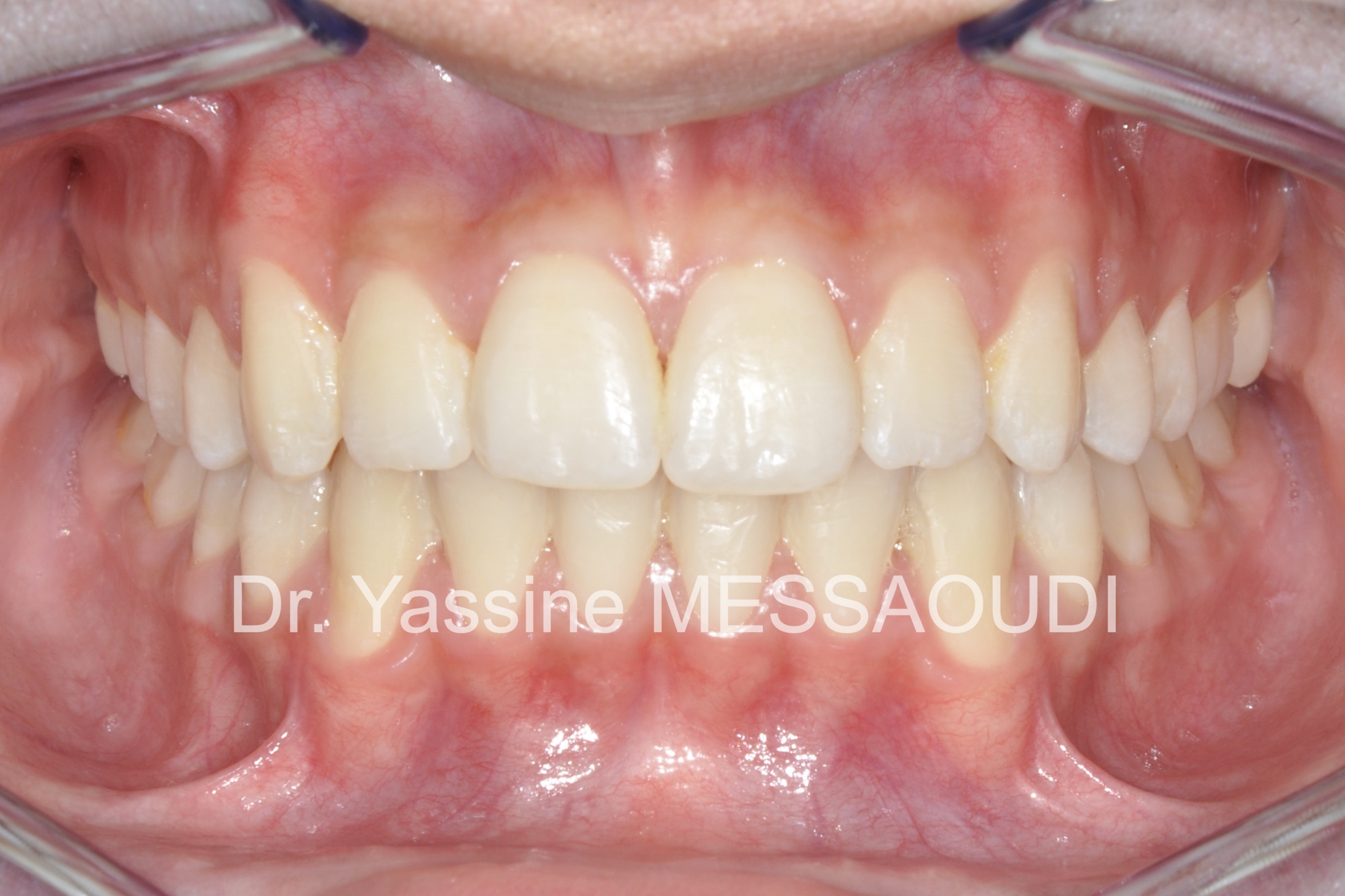 Adolescent - Après traitement