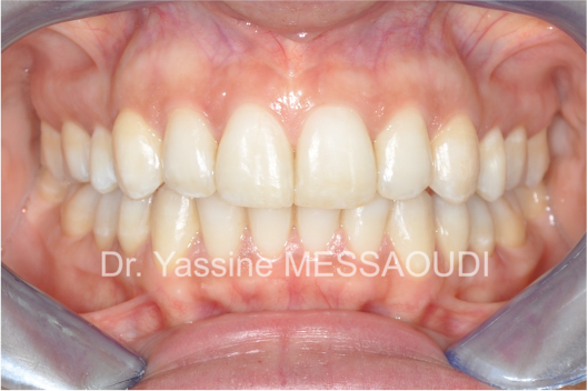 Adulte - Après traitement