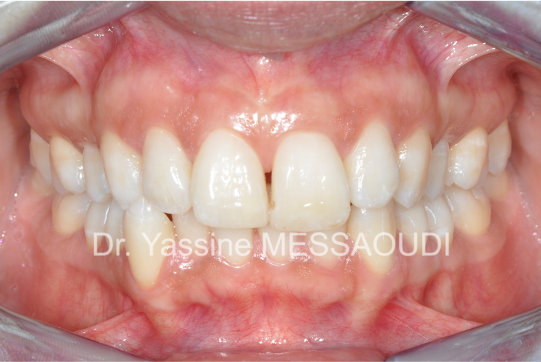 Adulte - Avant traitement