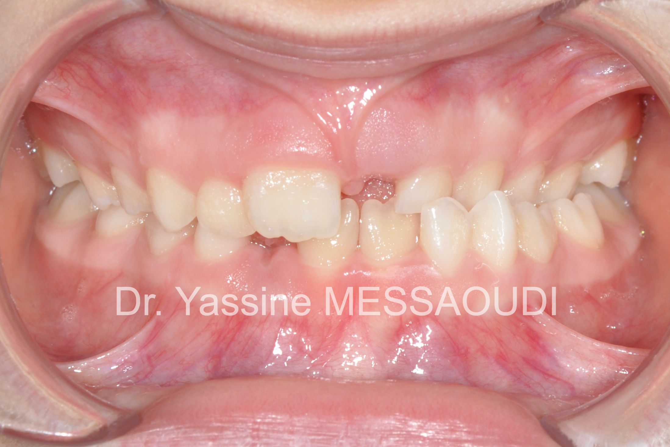 Enfant - Avant traitement